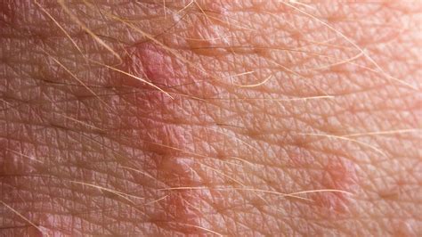 rashes that are similar to shingles